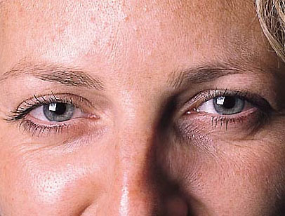 A photo of a person receiving Forehead treatment.