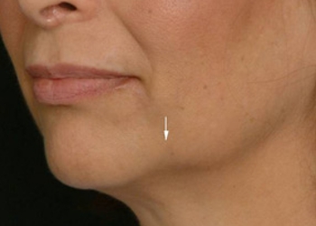 A photo of a person receiving Jowls treatment.