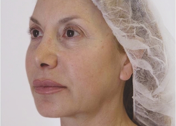 A photo of a person receiving Jowls treatment.