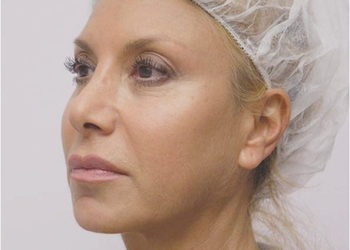 A photo of a person receiving Jowls treatment.