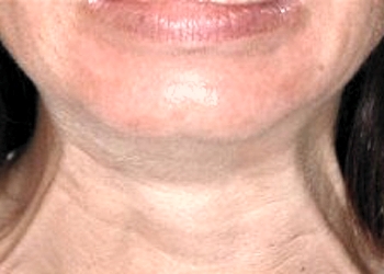 A photo of a person receiving Neck treatment.