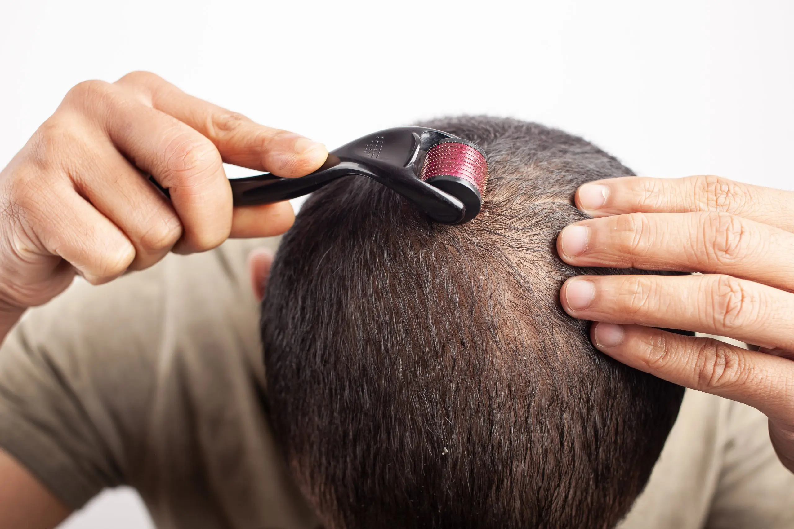 MICRO-NEEDLING