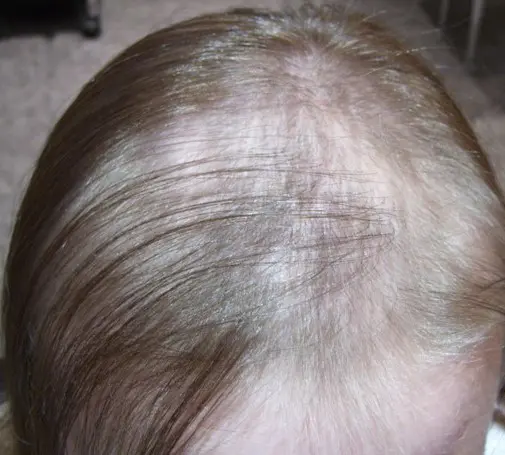 Diffuse Alopecia