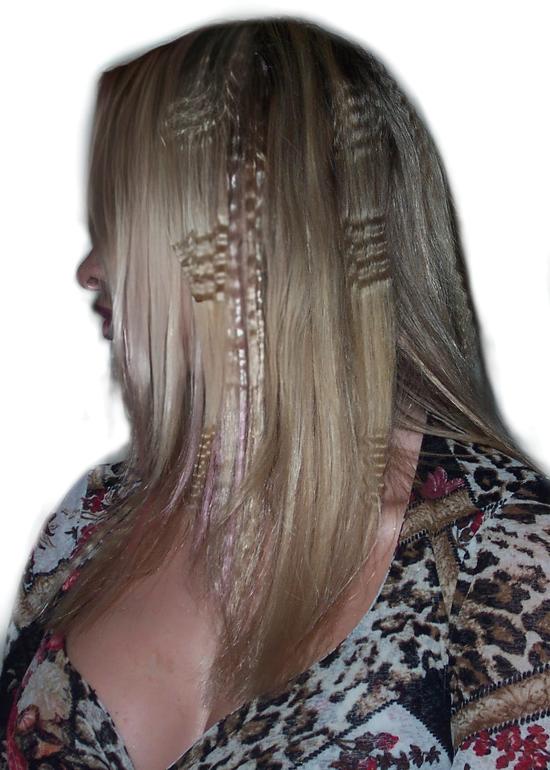 After Picture - Real Hair Extensions Bald Patches Recovery