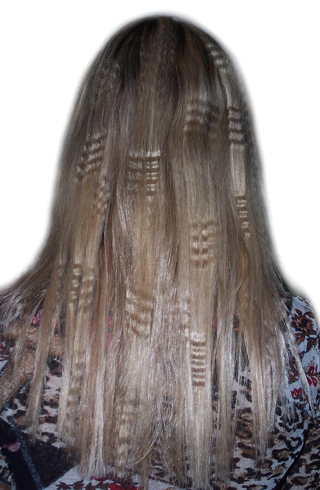 After Picture - Real Hair Extensions Bald Patches Recovery