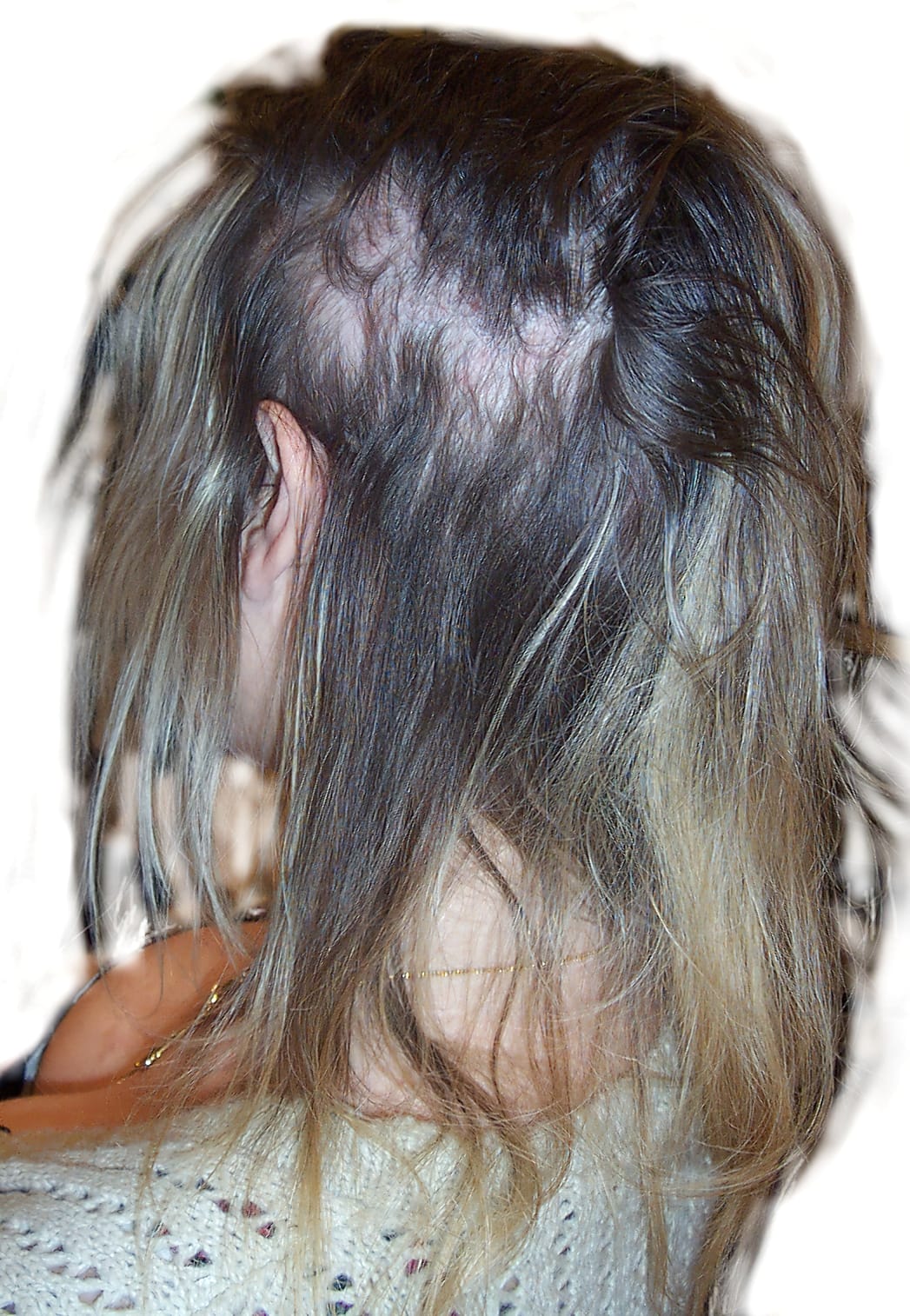 Before Picture - Real Hair Extensions Bald Patches Recovery