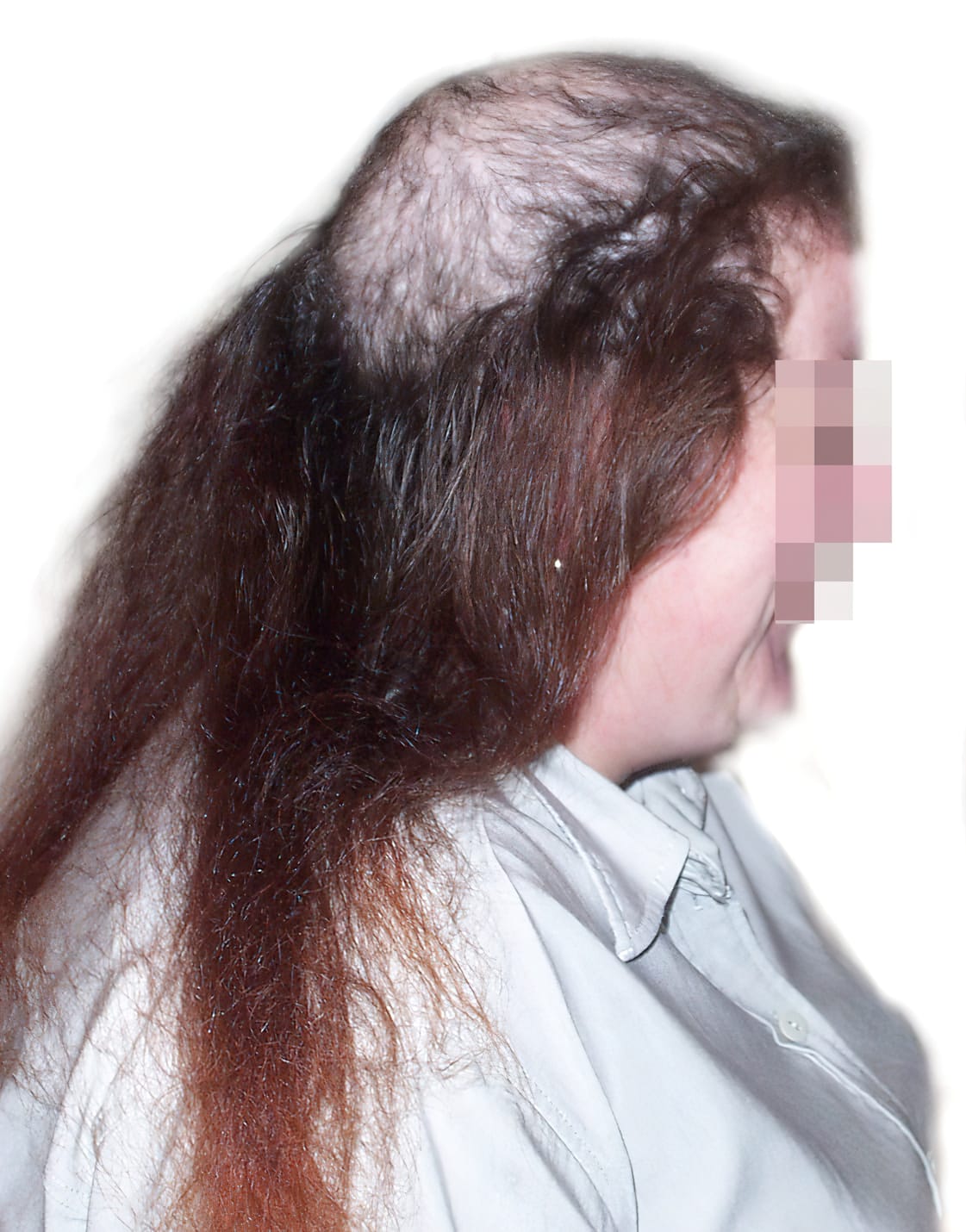 Before Picture - Trichotillomania Cosmetic Fix