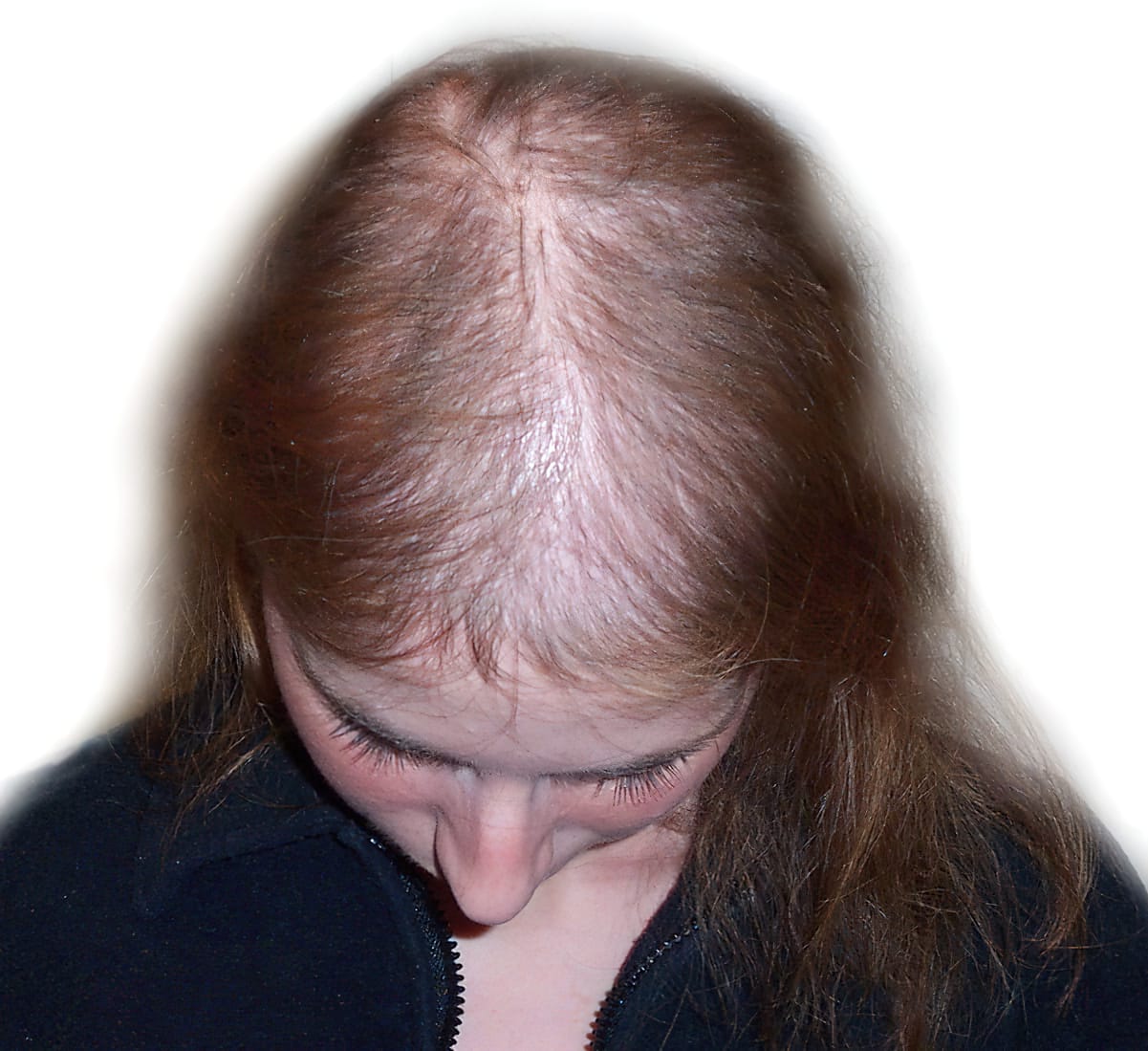 Before Picture - Androgenetic Alopecia Cosmetic Cover-Up