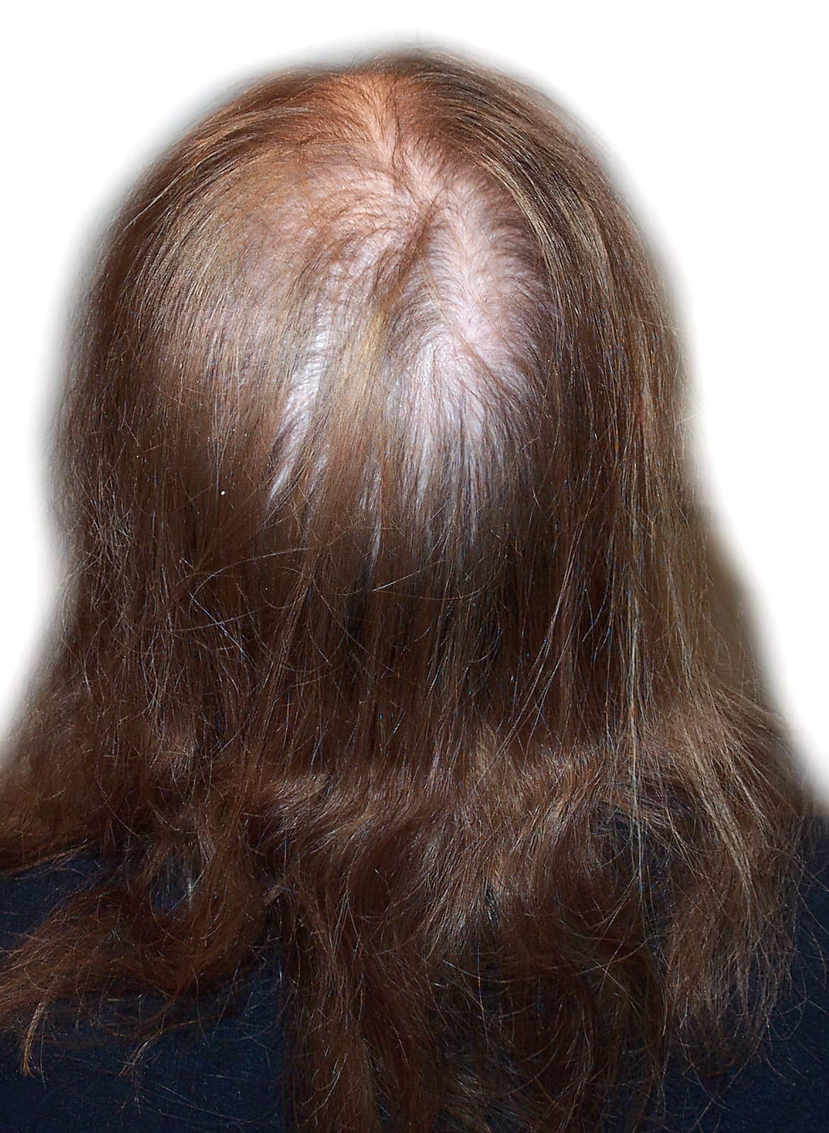 Before Picture - Androgenetic Alopecia Cosmetic Cover-Up