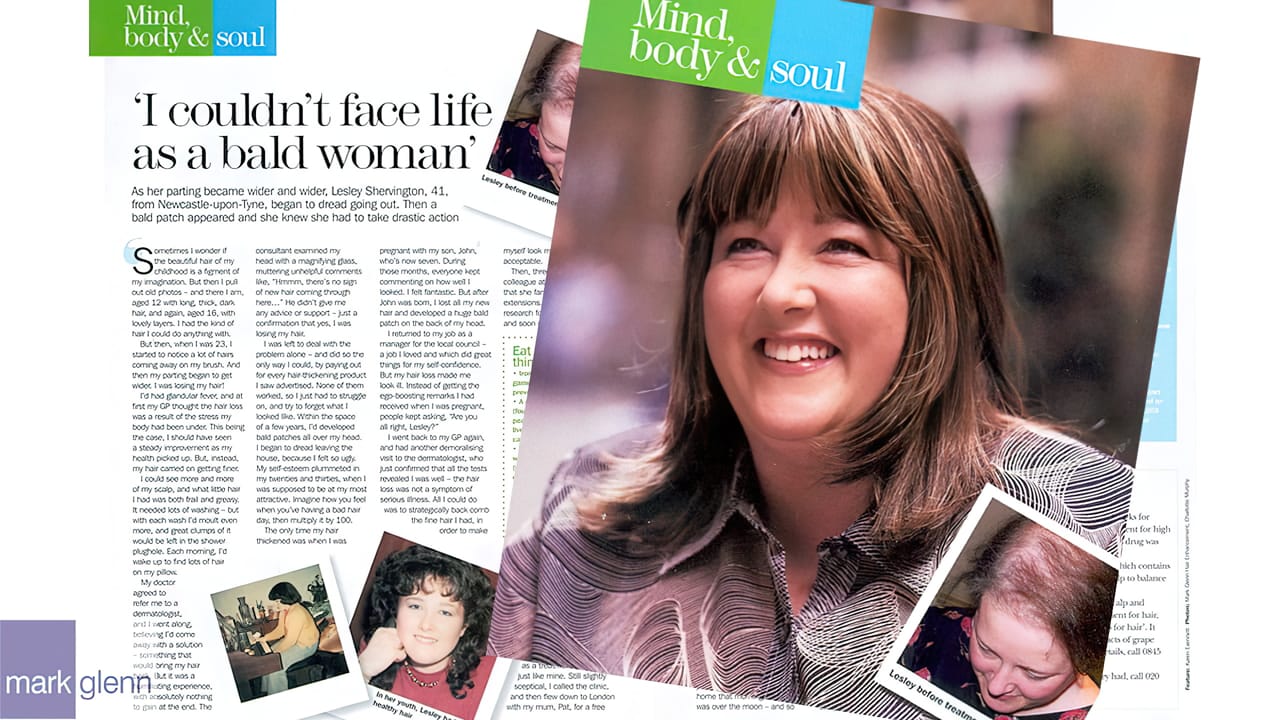 Androgenetic / Undiagnosed Alopecia