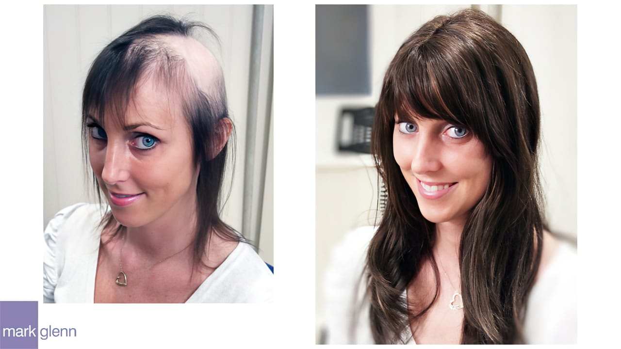 Radiotherapy & Surgery Hair Loss - No More Wigs