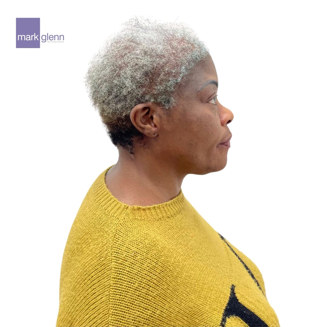 Before Picture - Afro Hair Loss Recovery - Semi-Permanent Alternative To Wigs