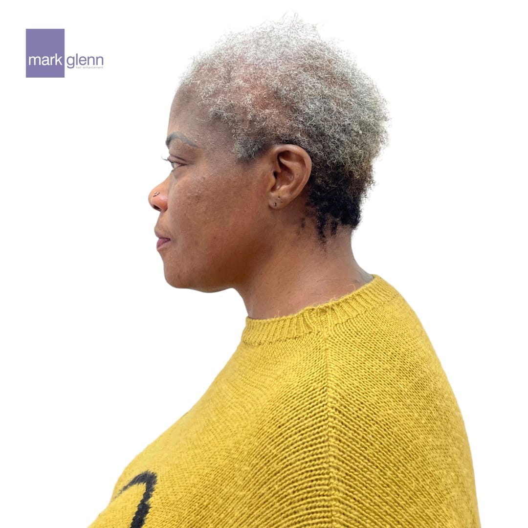 Before Picture - Afro Hair Loss Recovery - Semi-Permanent Alternative To Wigs