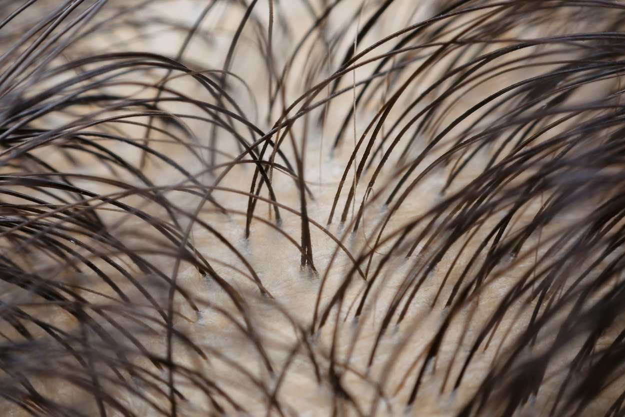 Telogen Effluvium