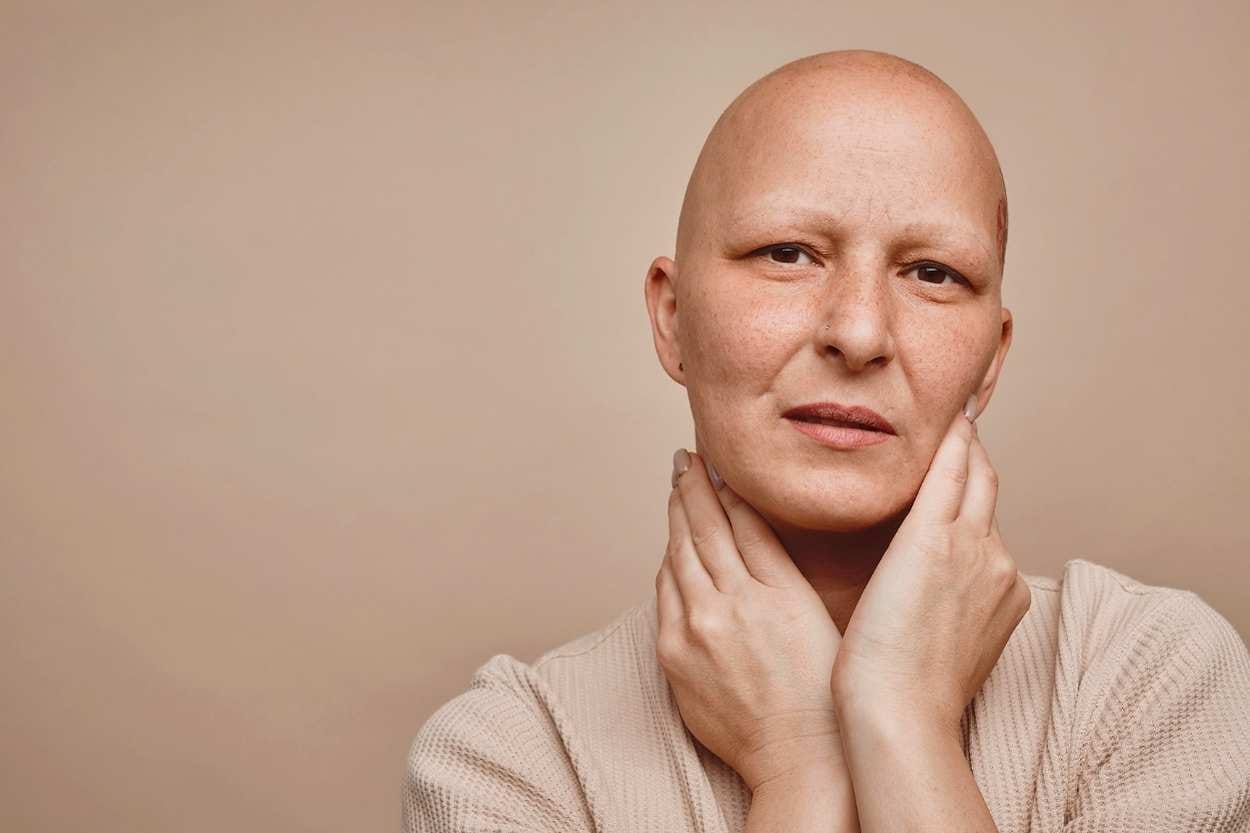 Alopecia Universalis