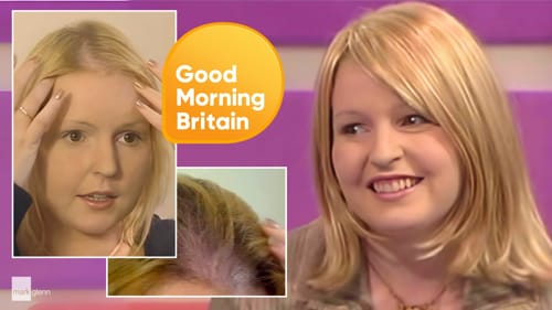 Hair Loss Miracle Makeover on LK Today, UK TV