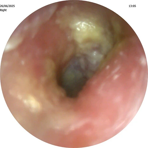 Infected Ear
