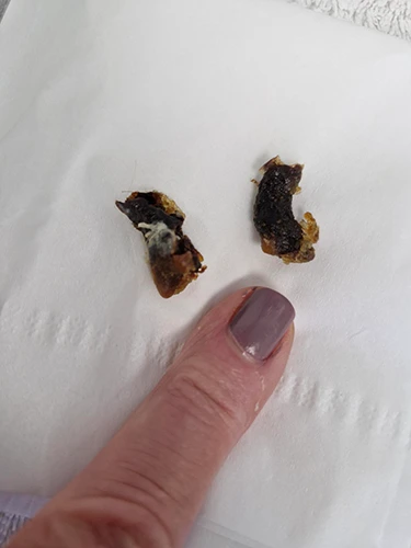 Two ear wax plugs on tissue paper with a finger pointing toward them